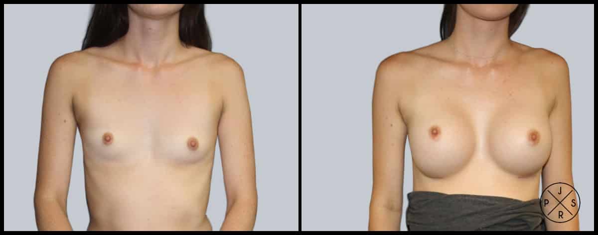 Breast Augmentation Before & After Image