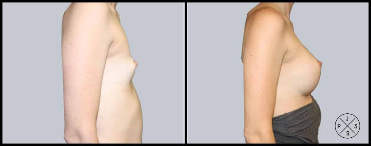 Breast Augmentation Before & After Image