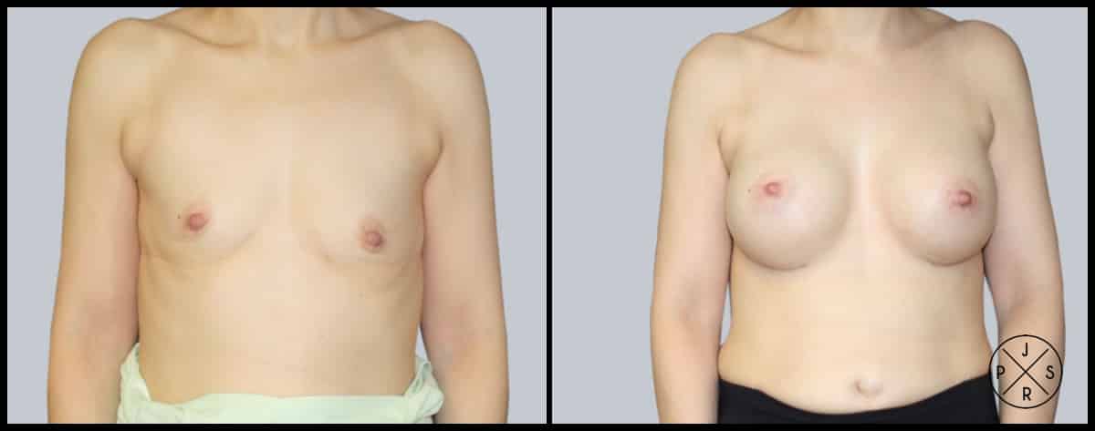 Breast Augmentation Before & After Image