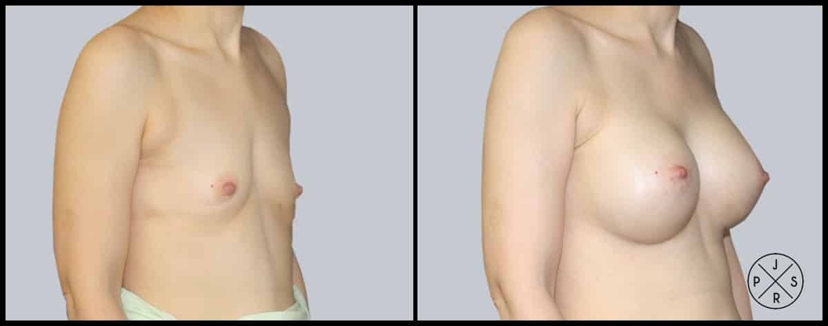 Breast Augmentation Before & After Image