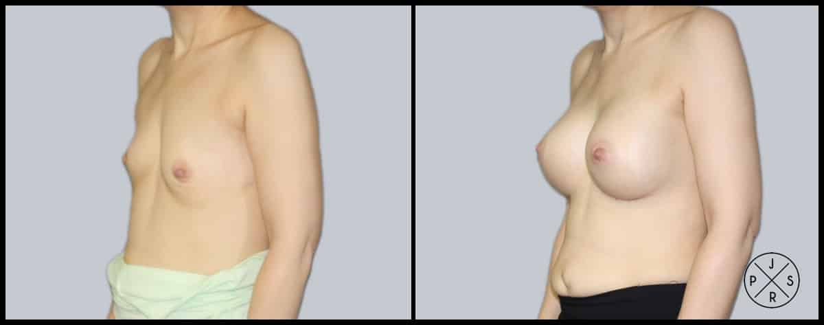 Breast Augmentation Before & After Image