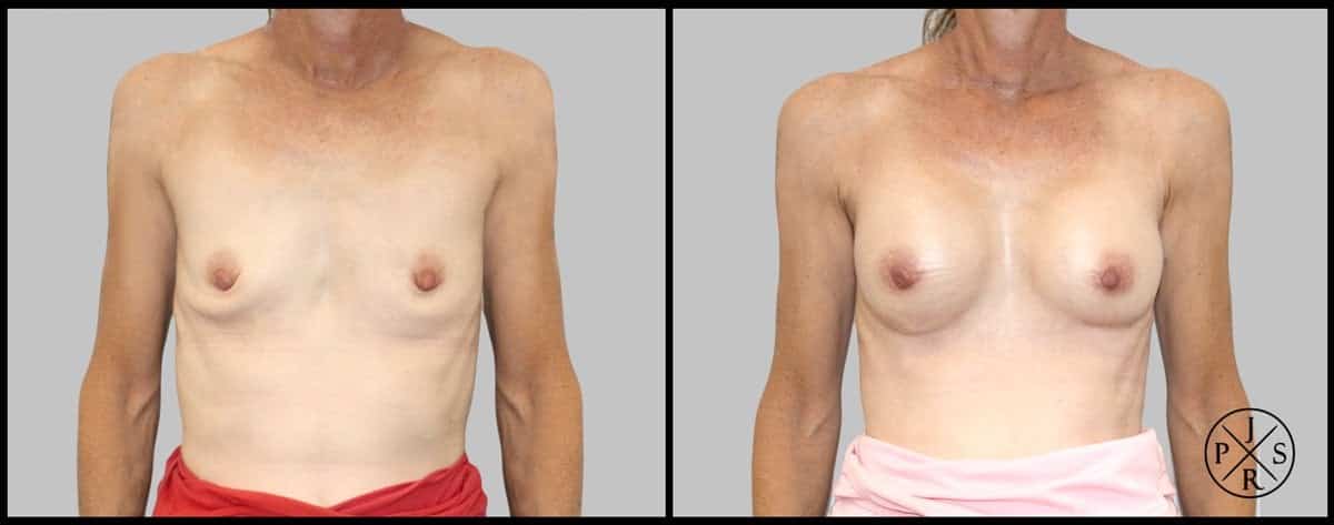 Breast Augmentation Before & After Image