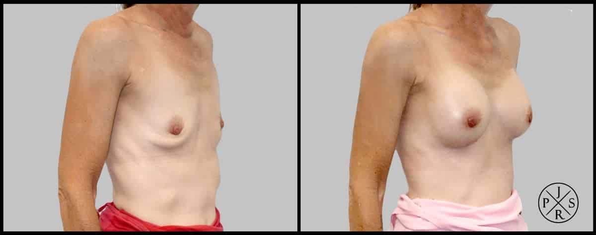 Breast Augmentation Before & After Image