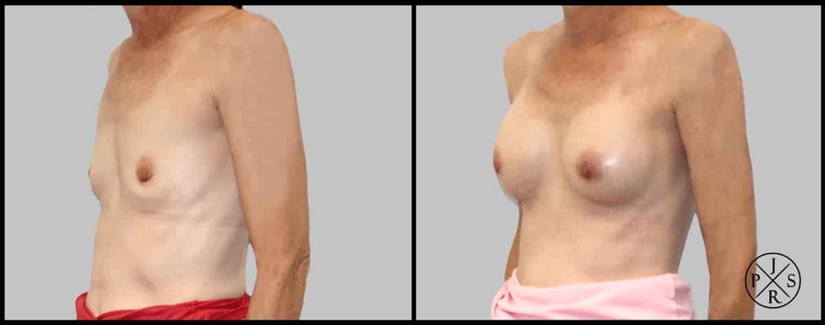 Breast Augmentation Before & After Image