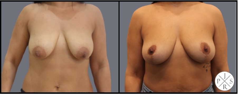 Breast Lift Before & After Image