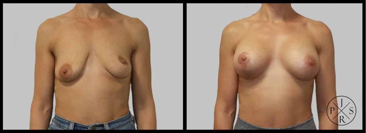 Breast Lift Before & After Image