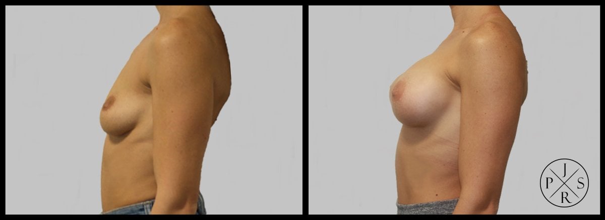 Breast Lift Before & After Image