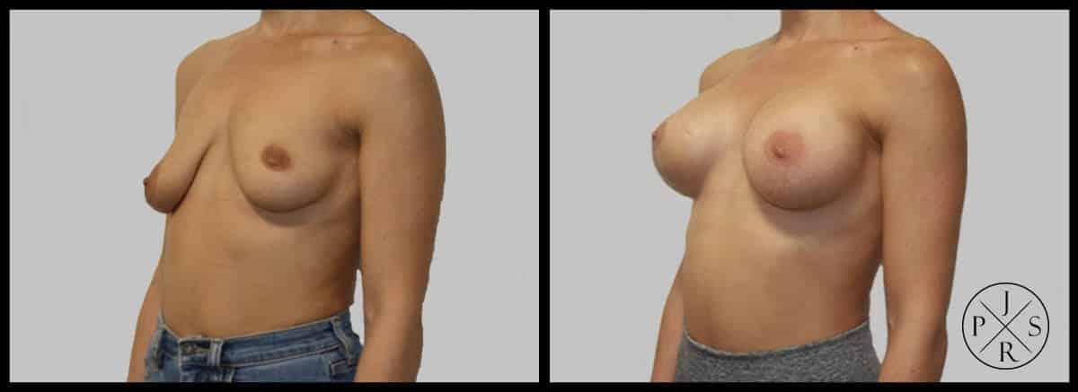 Breast Lift Before & After Image