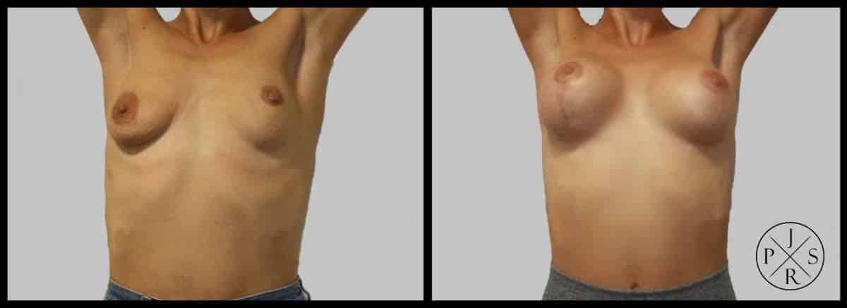 Breast Lift Before & After Image