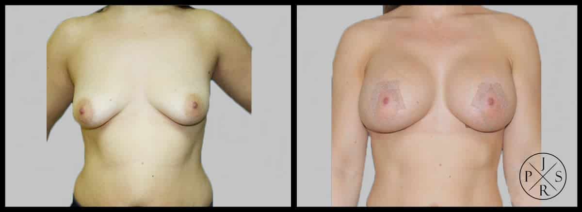 Breast Lift Before & After Image