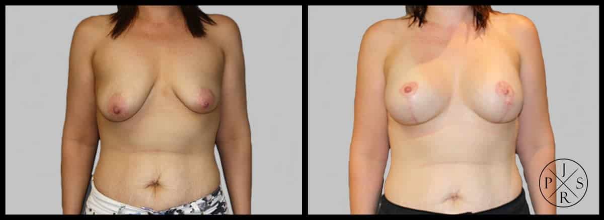 Breast Lift Before & After Image