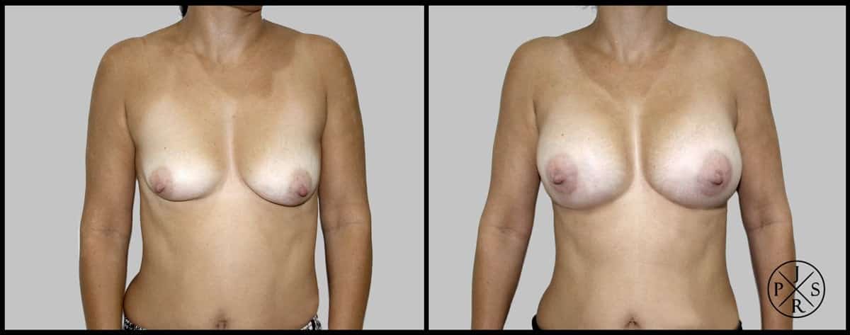 Breast Reconstruction Before & After Image