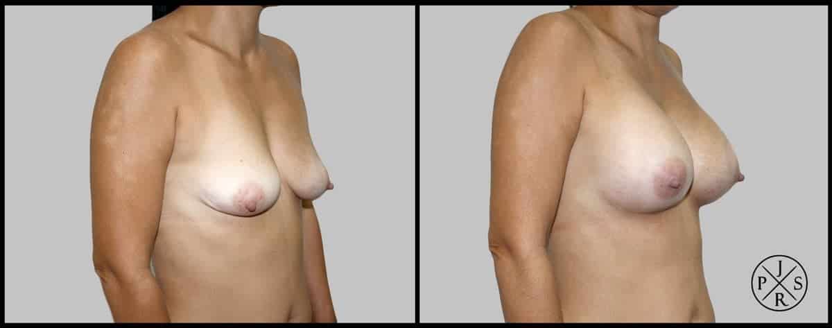 Breast Reconstruction Before & After Image