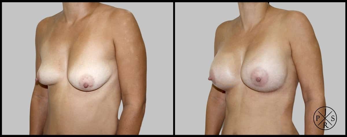 Breast Reconstruction Before & After Image