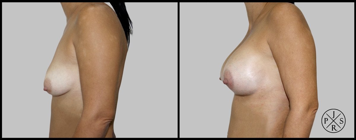 Breast Reconstruction Before & After Image