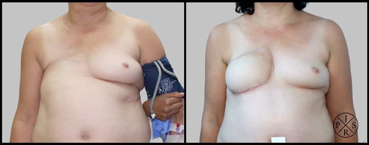 Breast Reconstruction Before & After Image