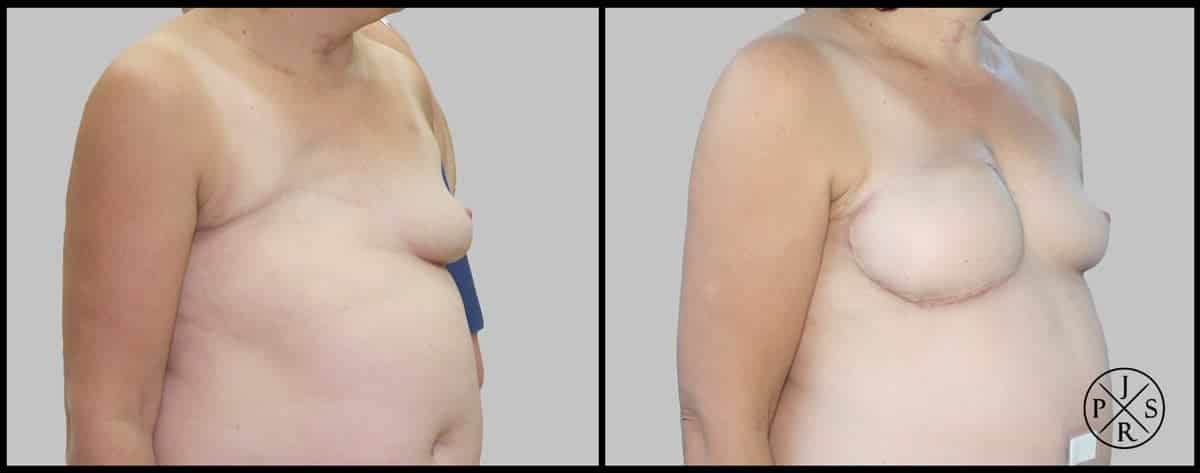 Breast Reconstruction Before & After Image