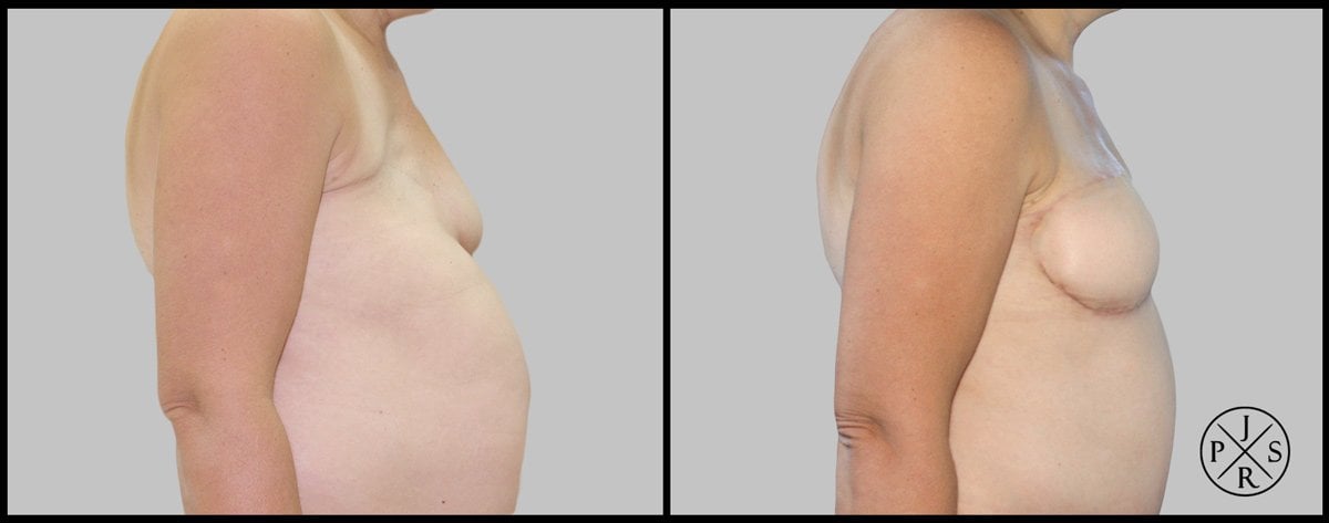 Breast Reconstruction Before & After Image