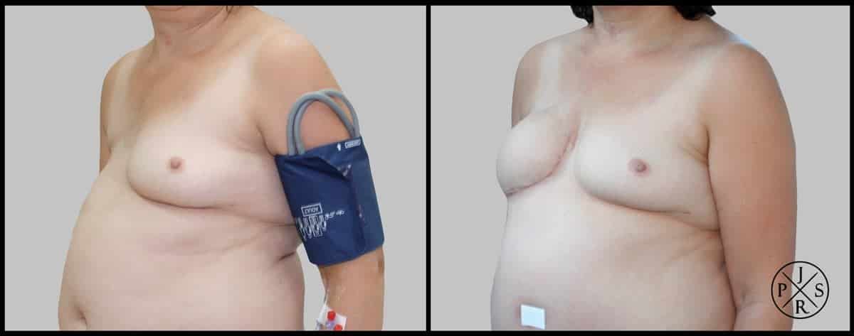 Breast Reconstruction Before & After Image