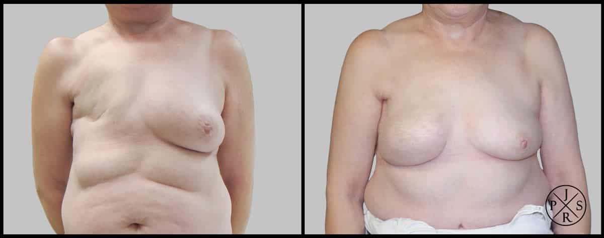 Breast Reconstruction Before & After Image