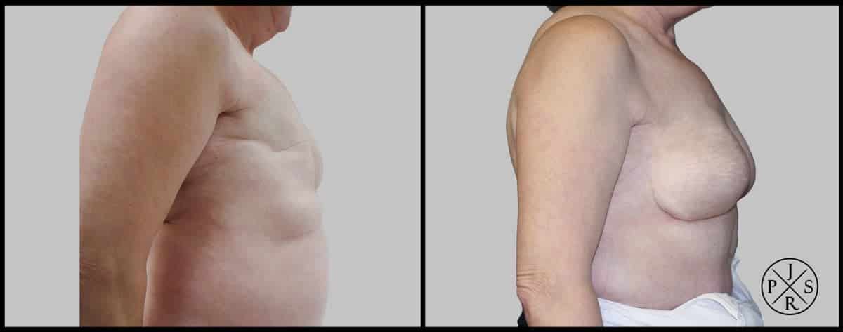 Breast Reconstruction Before & After Image