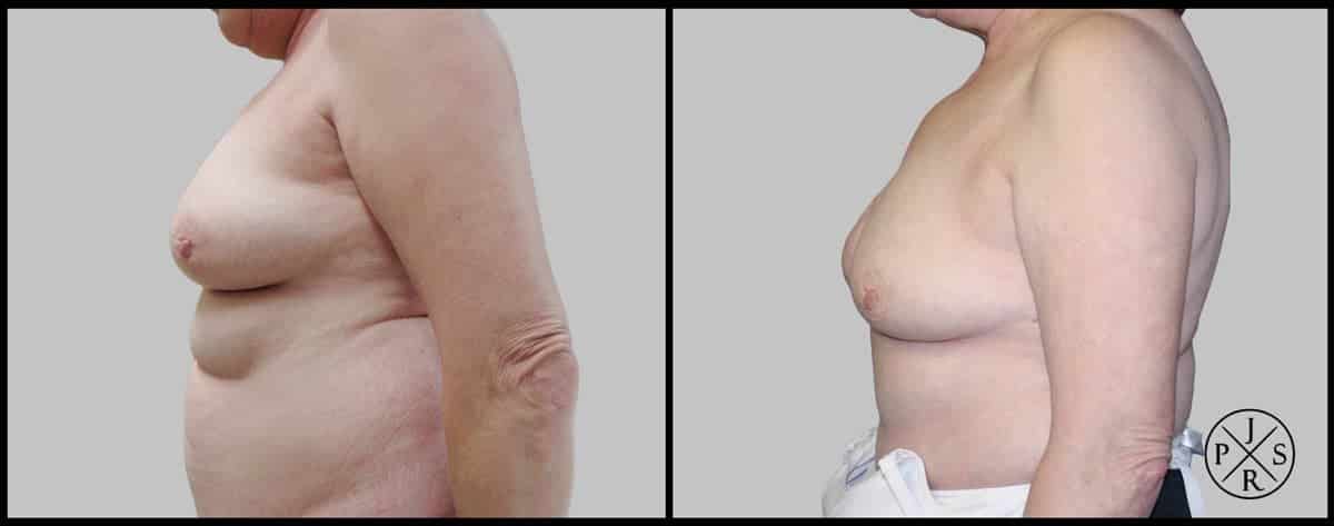 Breast Reconstruction Before & After Image