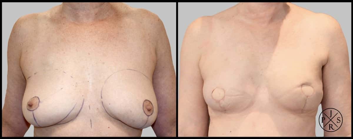 Breast Reconstruction Before & After Image