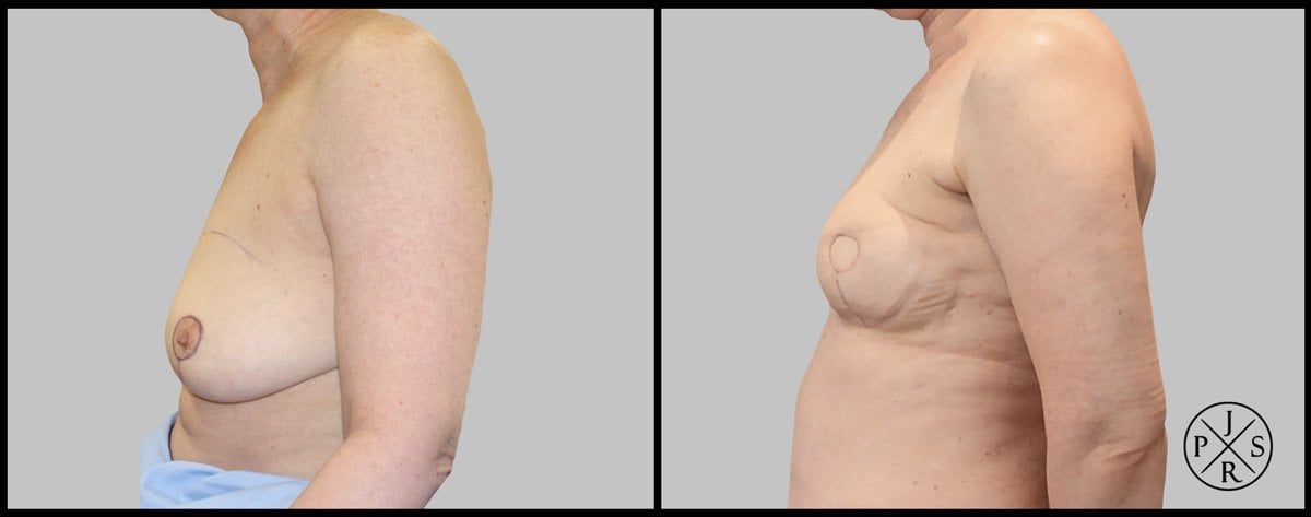 Breast Reconstruction Before & After Image