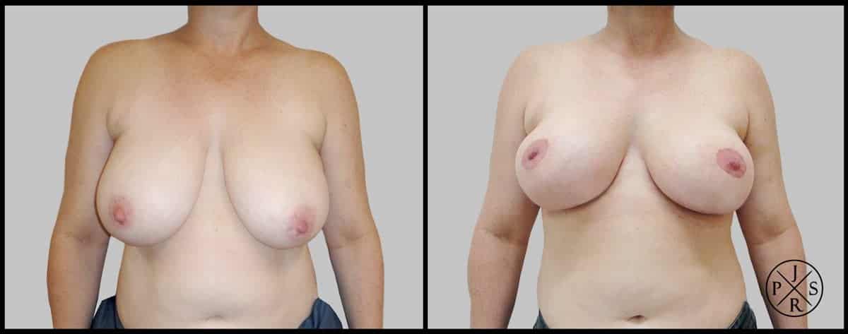 Breast Reduction Before & After Image