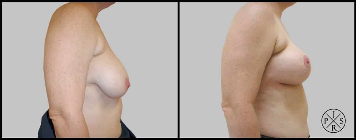 Breast Reduction Before & After Image