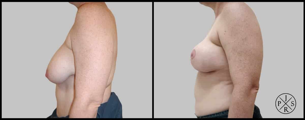 Breast Reduction Before & After Image