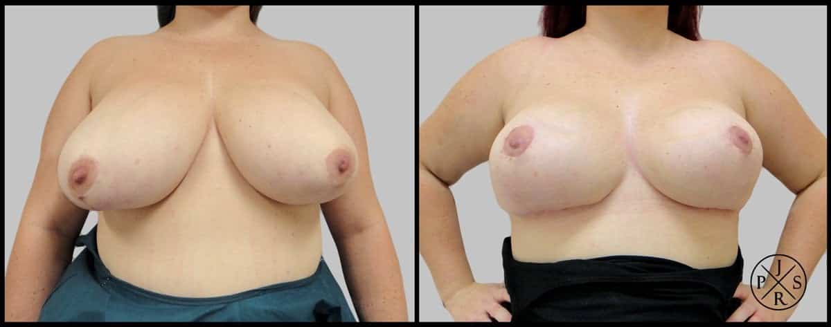 Breast Reduction Before & After Image