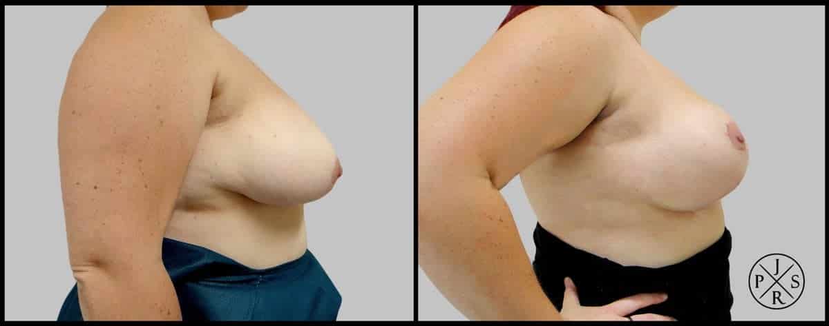 Breast Reduction Before & After Image