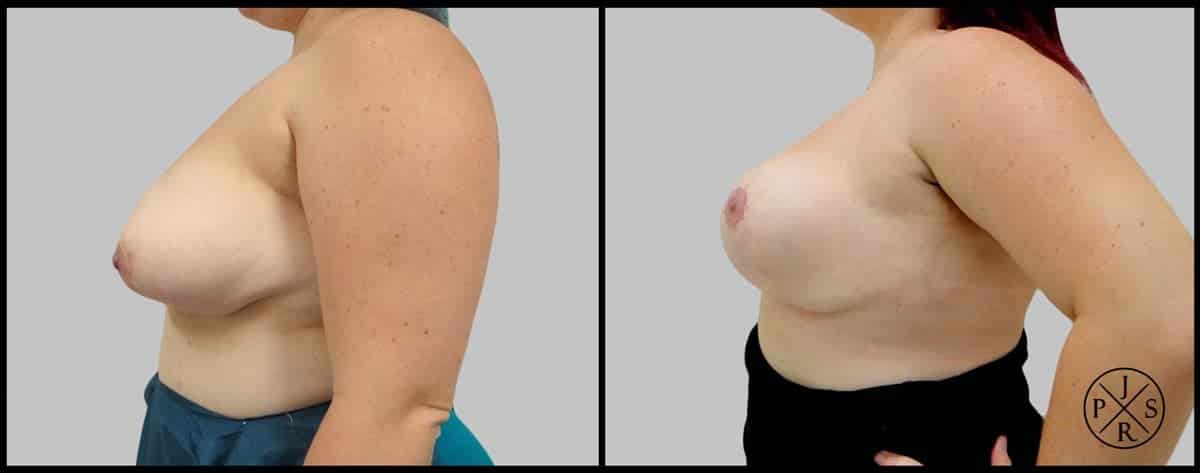 Breast Reduction Before & After Image