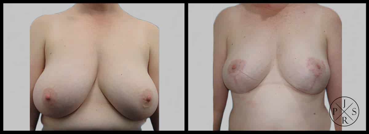 Breast Reduction Before & After Image