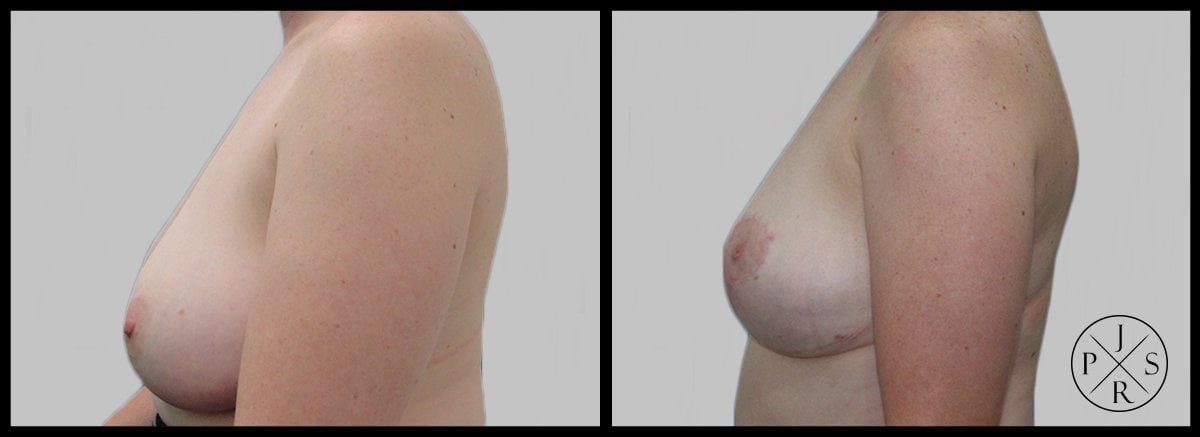 Breast Reduction Before & After Image