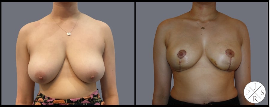 Breast Reduction Before & After Image