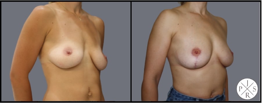 Fat Transfer Breast Augmentation Before & After Image