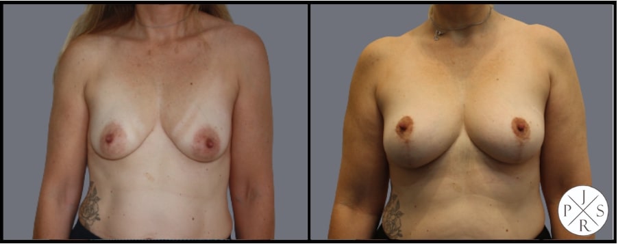 Fat Transfer Breast Augmentation Before & After Image