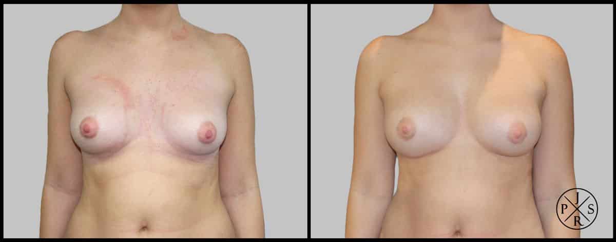 Fat Transfer Breast Augmentation Before & After Image