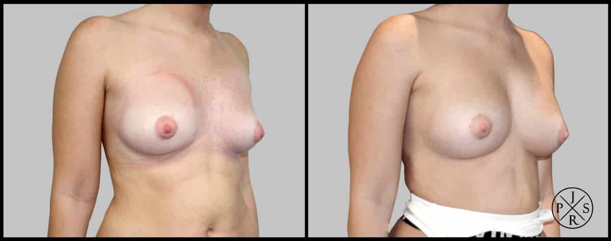 Fat Transfer Breast Augmentation Before & After Image