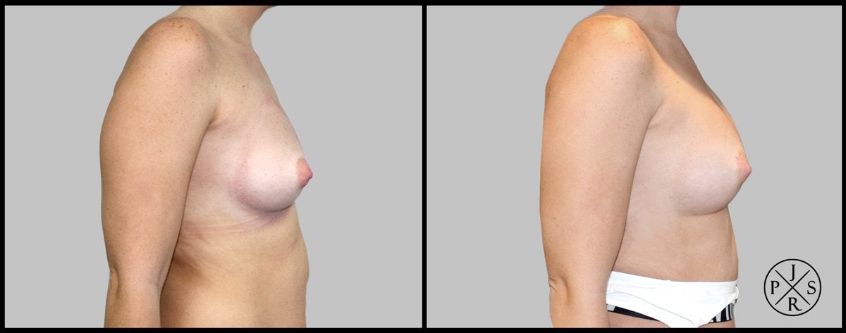 Fat Transfer Breast Augmentation Before & After Image