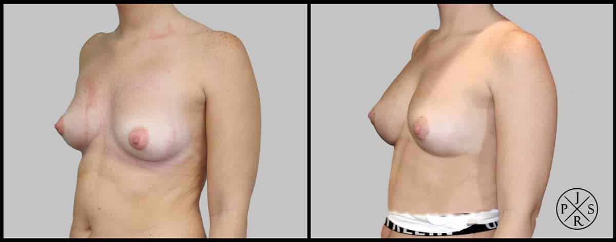 Fat Transfer Breast Augmentation Before & After Image