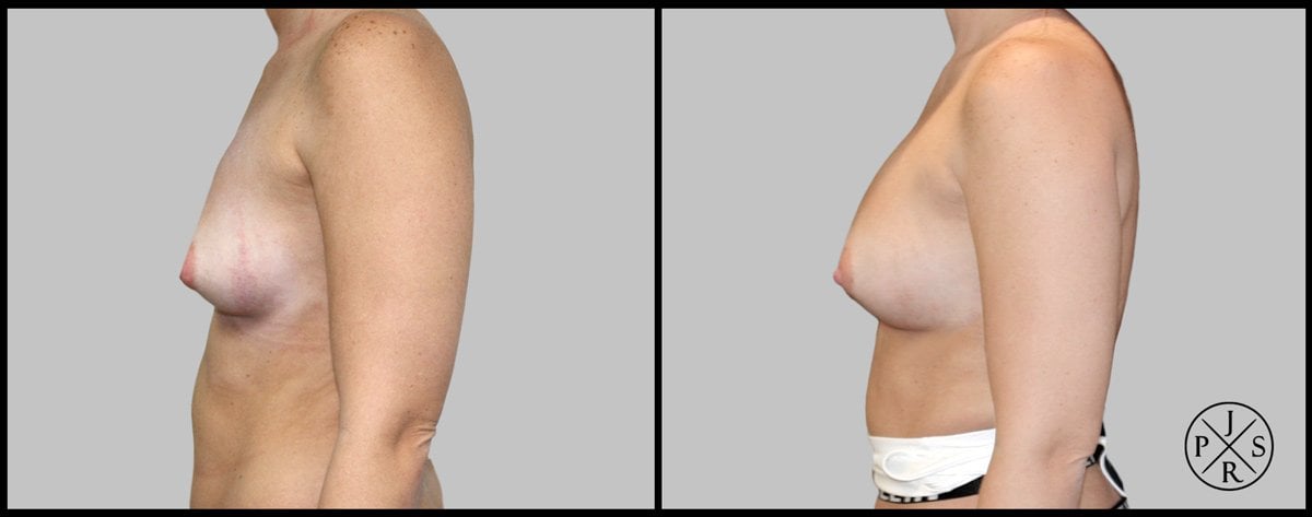 Fat Transfer Breast Augmentation Before & After Image