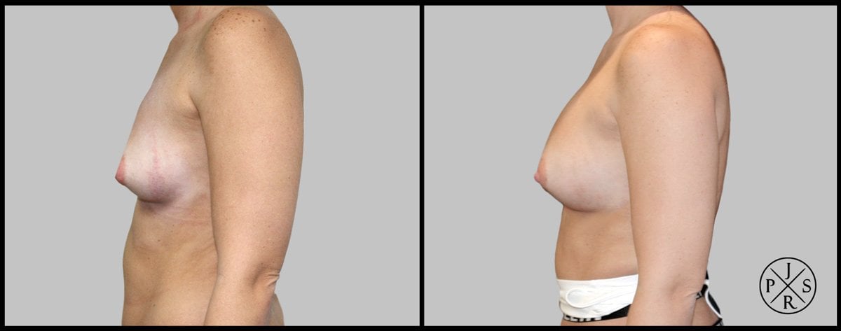 Fat Transfer Breast Augmentation Before & After Image