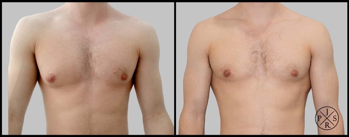 Gynaecomastia Surgery Before & After Image