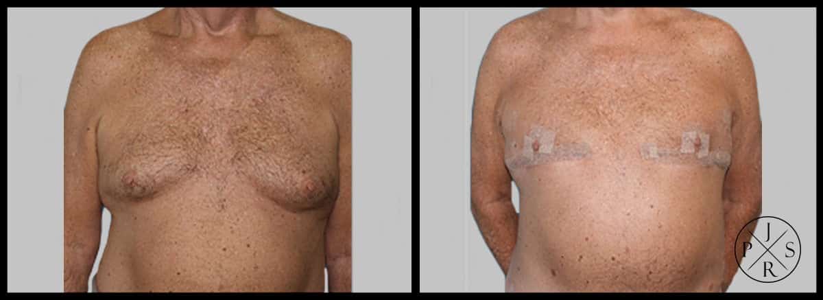 Gynaecomastia Surgery Before & After Image