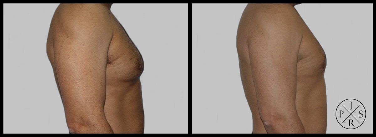 Gynaecomastia Surgery Before & After Image