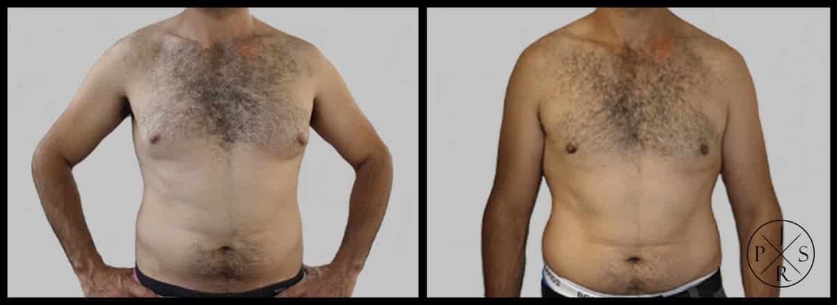 Gynaecomastia Surgery Before & After Image