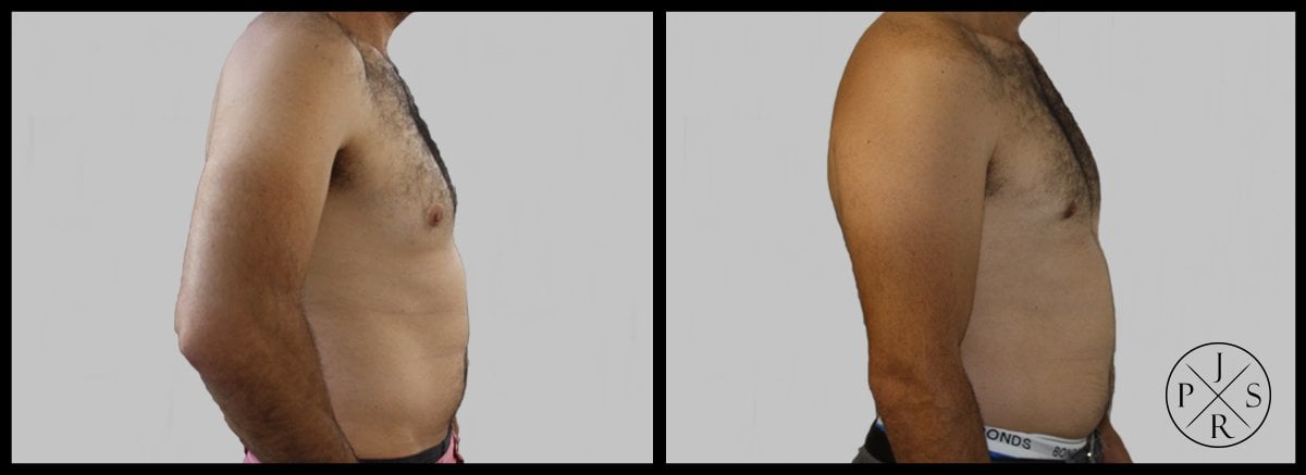 Gynaecomastia Surgery Before & After Image